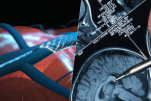 Synchron quiere aumentar su ventaja con Neuralink en la carrera por los chips cerebrales. Con un ensayo clínico masivo