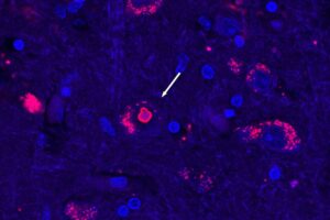 Llevábamos 25 años buscando el origen genético de una enfermedad neurológica rara. Acabamos de encontrarlo