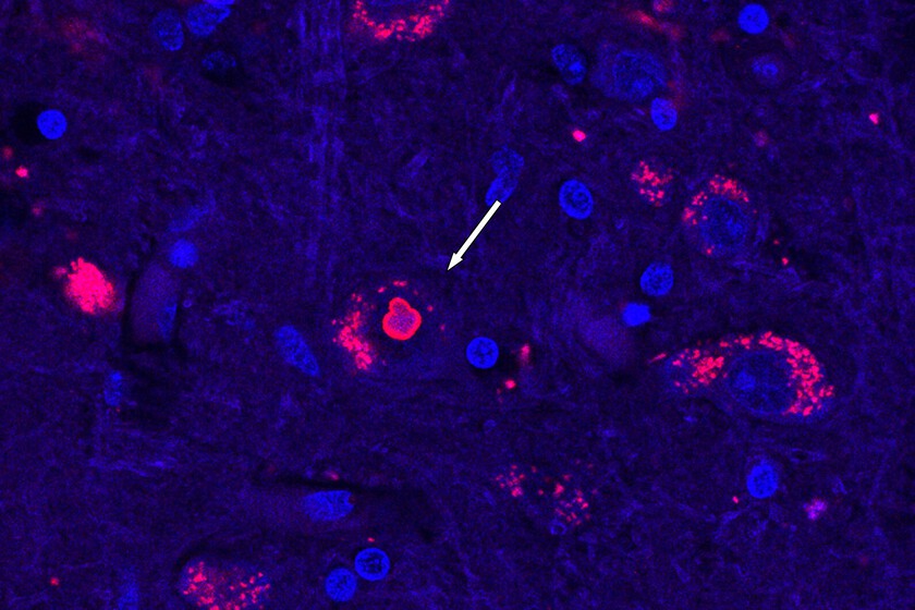 Llevábamos 25 años buscando el origen genético de una enfermedad neurológica rara. Acabamos de encontrarlo