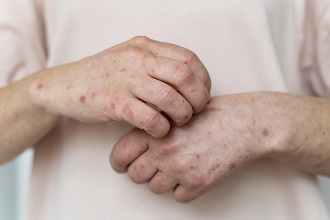 Venezuela activa un plan de vigilancia epidemiológica contra la mpox