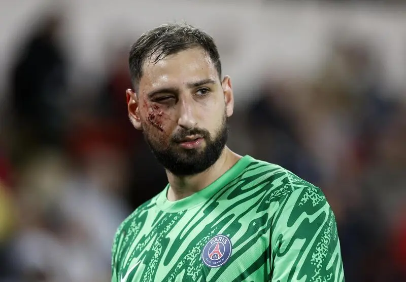 Donnarumma, tras sufrir una herida en la cara. EFE/EPA/SEBASTIEN NOGIER